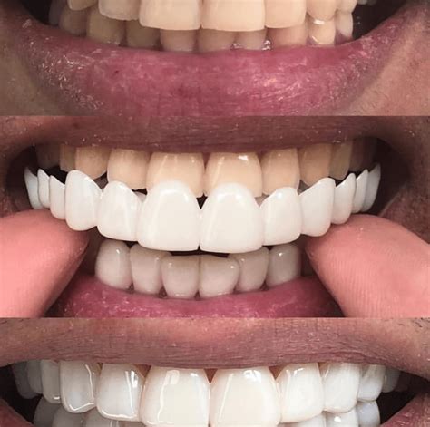 Magic teeth brace perfect smile veneerss